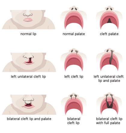cleft lip treatment virginia