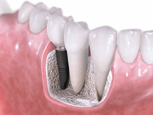 dental implants arlington va