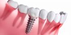 molar implant