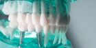 dental implant